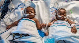 Nigerian Conjoined Twins Separated