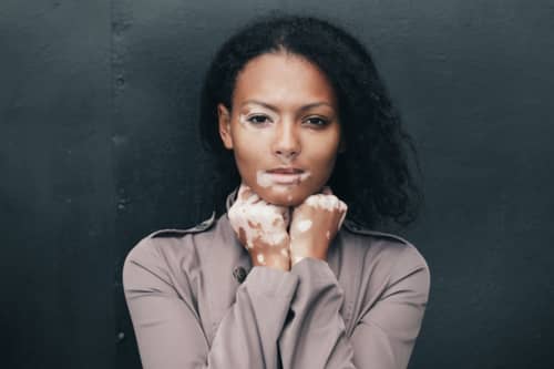Understanding Vitiligo