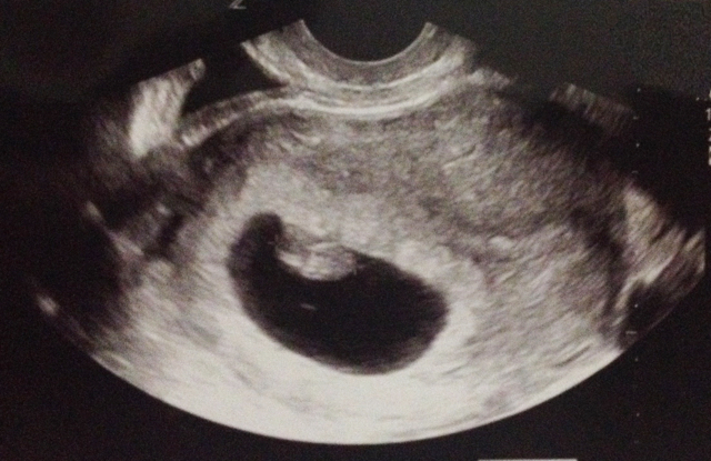 From 2 Miscarriages to Positivity: Over 35 And Pregnant