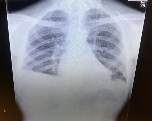 Human Lungs Are Carrying Microplastics