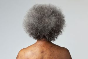 black skin conditions
