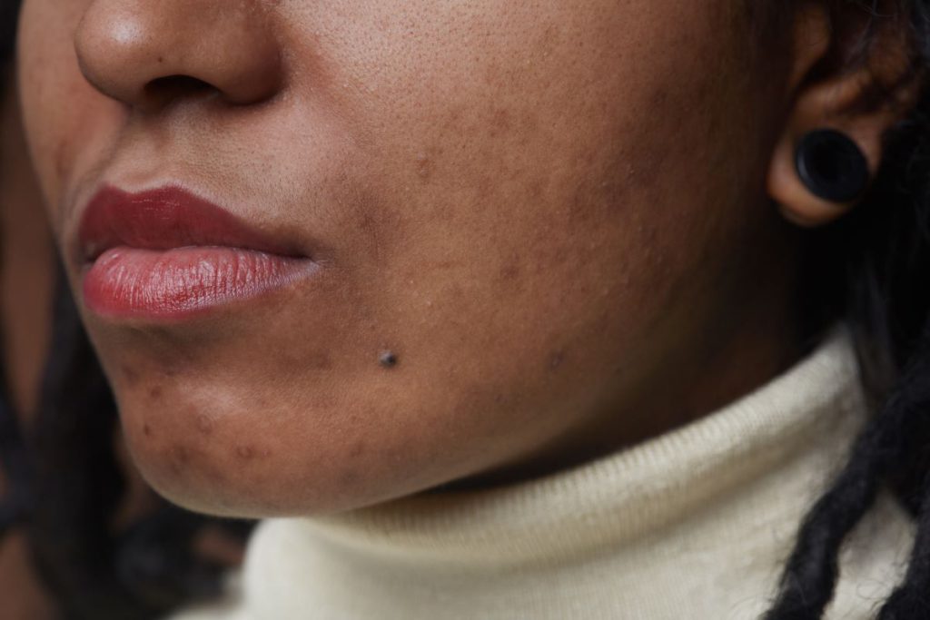 black skin disease