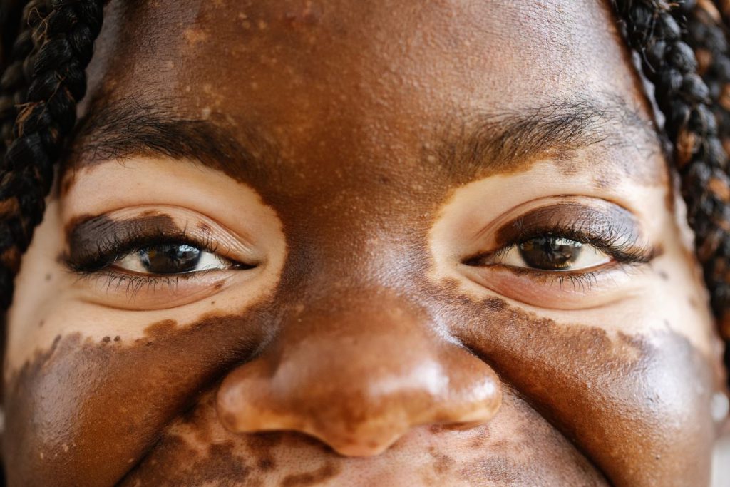 skin conditions in black skin