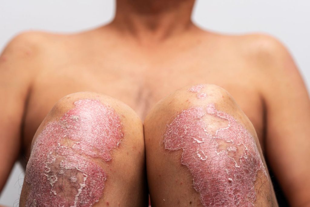 skin conditions in black skin