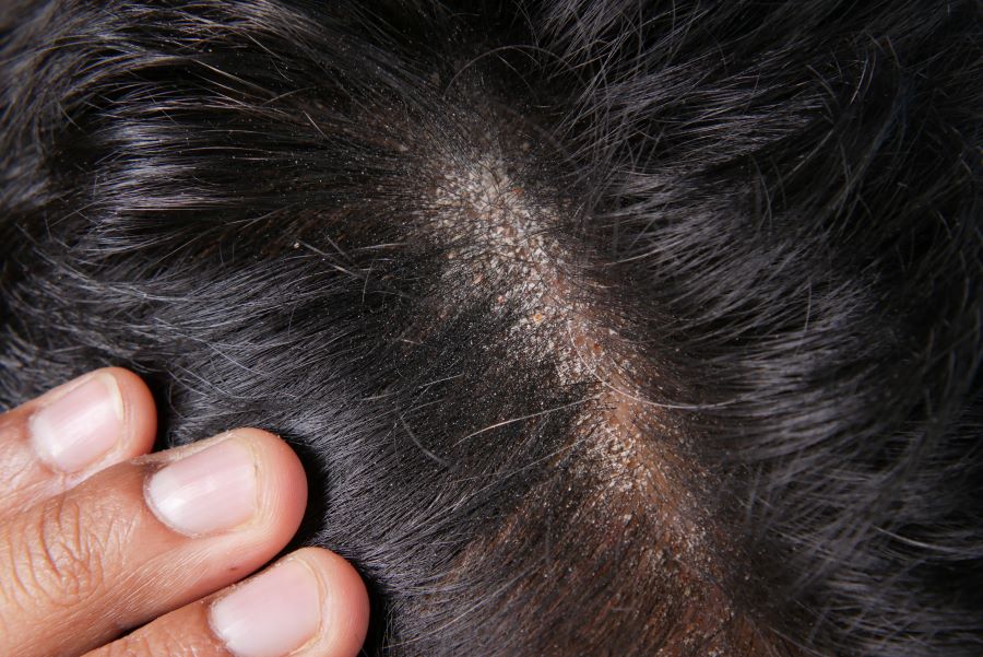 Scalp irritation from hair color